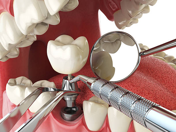 Best Emergency Dental Extractions in Buffalo, NY